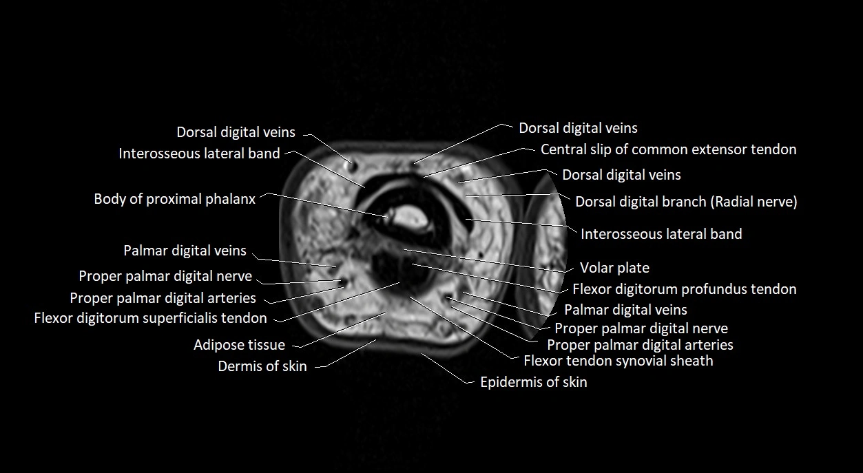 Finger anatomy axial cross sectional 3T image image 15.webp